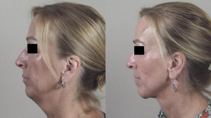 Neck Contouring Case 1306 Before & After Side Profile | Paramus, New Jersey | Parker Center for Plastic Surgery