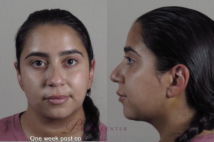 Neck Contouring Case 1352 Before & After 1 week  | Paramus, New Jersey | Parker Center for Plastic Surgery