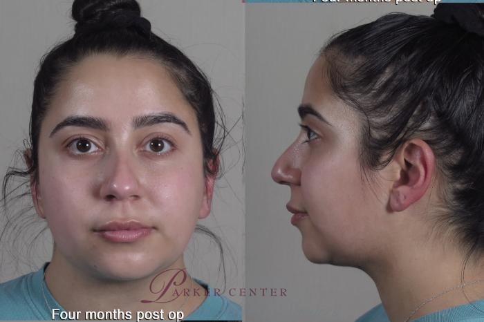 Neck Contouring Case 1352 Before & After months  | Paramus, New Jersey | Parker Center for Plastic Surgery