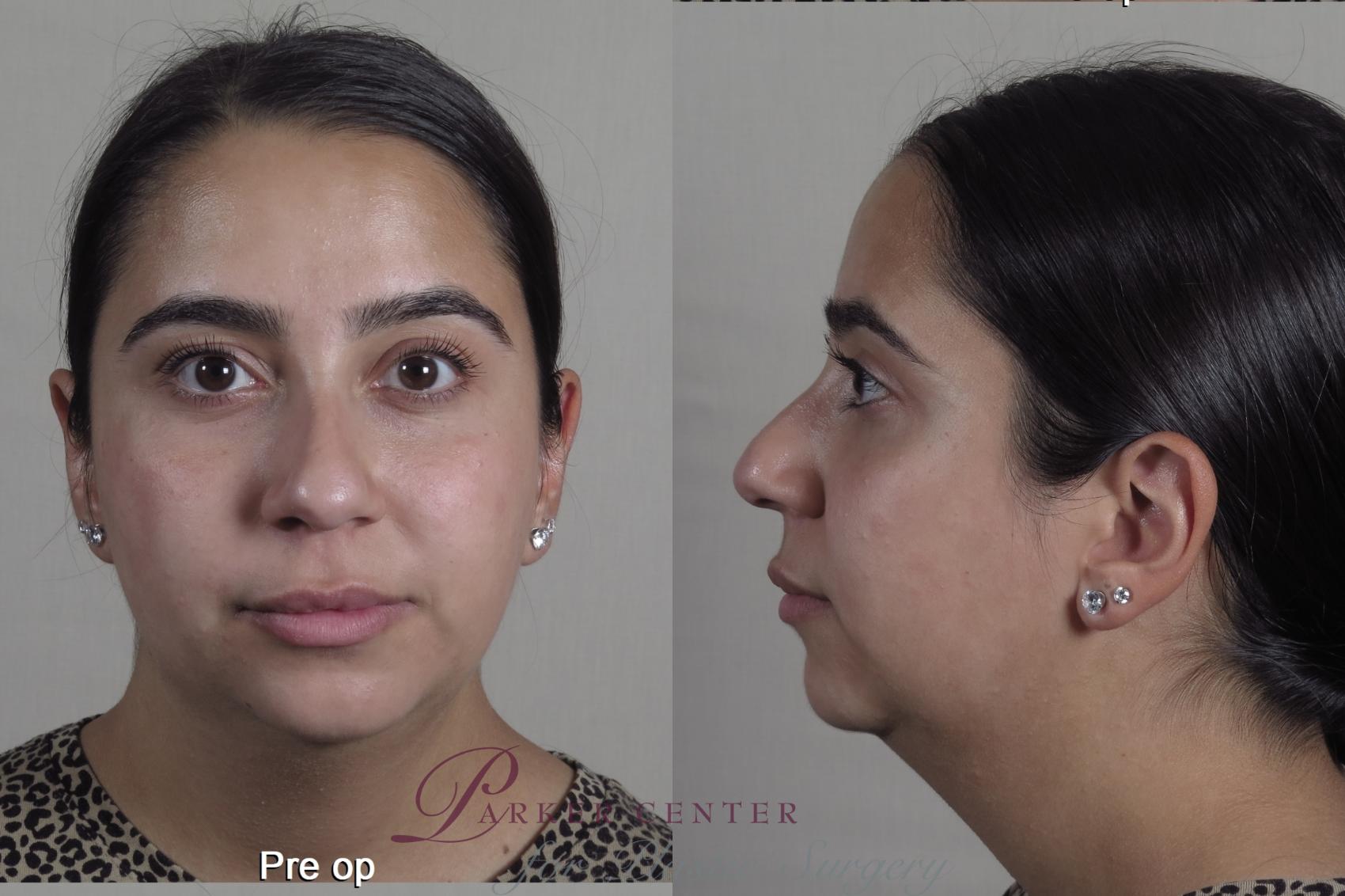 Neck Contouring Case 1352 Before & After pre op  | Paramus, New Jersey | Parker Center for Plastic Surgery