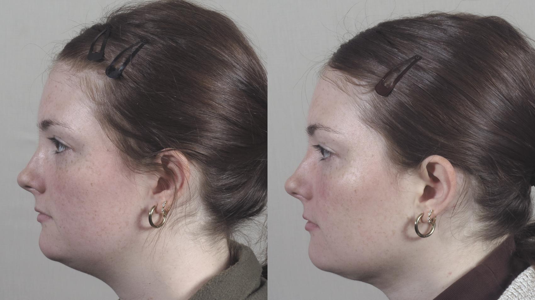 Neck Contouring Case 1391 Before & After Right Side | Paramus, New Jersey | Parker Center for Plastic Surgery