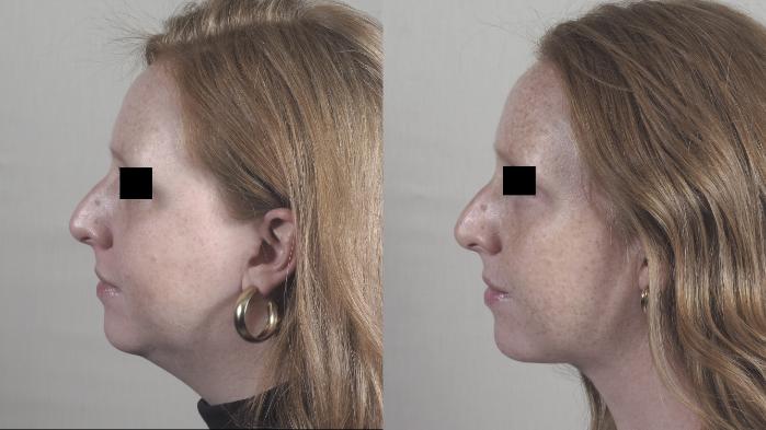 Neck Contouring Case 1481 Before & After Left Side | Paramus, New Jersey | Parker Center for Plastic Surgery