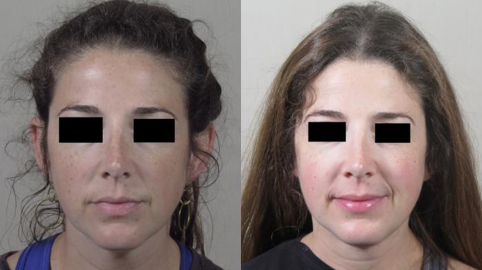 Neck Contouring Case 1526 Before & After Front | Paramus, New Jersey | Parker Center for Plastic Surgery