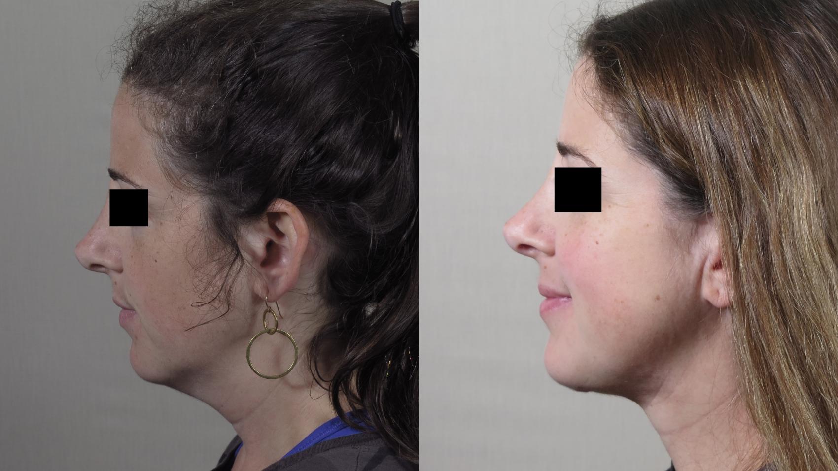 Neck Contouring Case 1526 Before & After Left Side | Paramus, New Jersey | Parker Center for Plastic Surgery