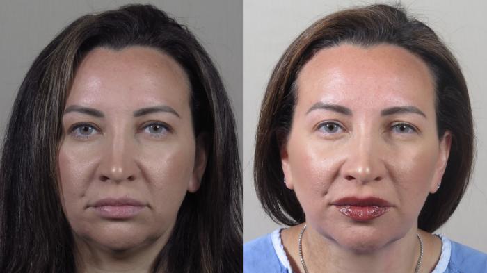 Neck Contouring Case 1529 Before & After Front | Paramus, New Jersey | Parker Center for Plastic Surgery