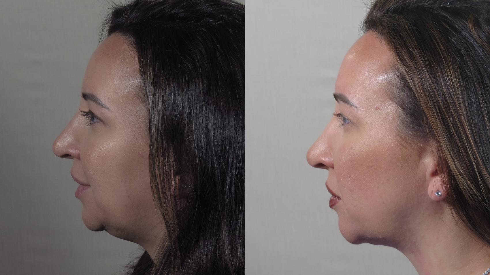 Neck Contouring Case 1529 Before & After Left Side | Paramus, New Jersey | Parker Center for Plastic Surgery