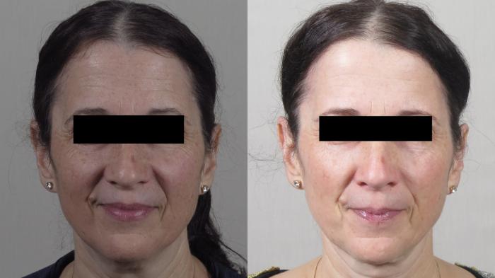 Neck Contouring Case 1538 Before & After Front | Paramus, New Jersey | Parker Center for Plastic Surgery