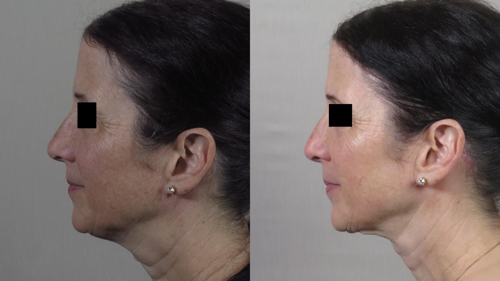 Neck Contouring Case 1538 Before & After Left Side | Paramus, New Jersey | Parker Center for Plastic Surgery