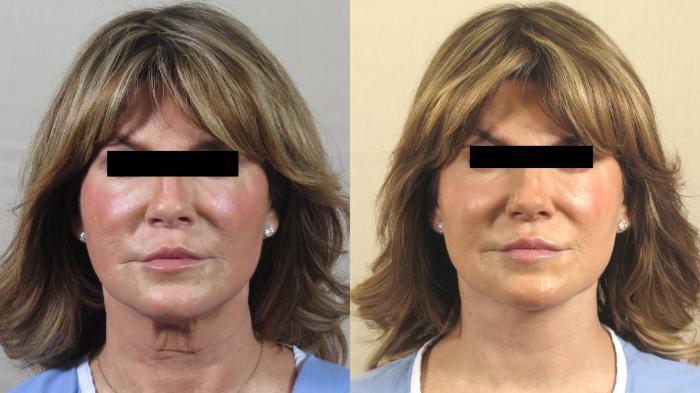 Neck Contouring Case 1549 Before & After Front | Paramus, New Jersey | Parker Center for Plastic Surgery