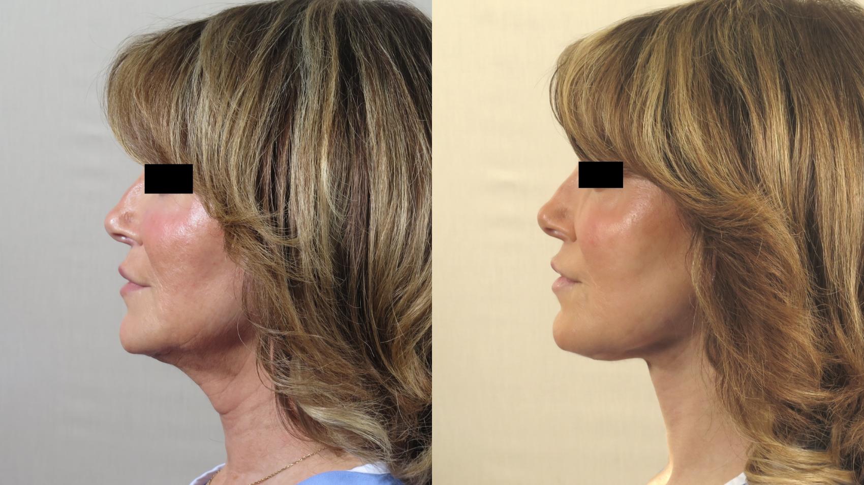 Neck Contouring Case 1549 Before & After Left Side | Paramus, New Jersey | Parker Center for Plastic Surgery