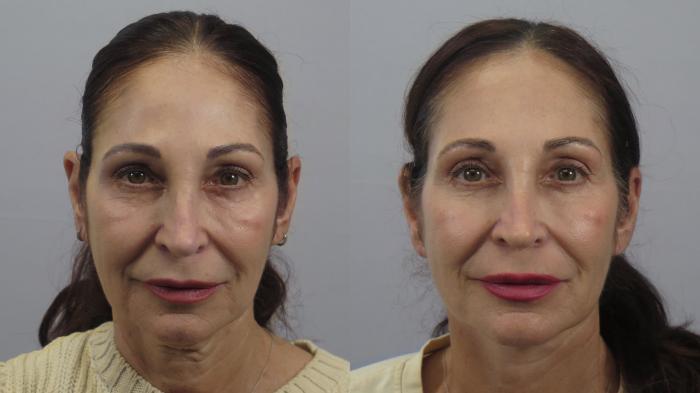 Neck Contouring Case 1579 Before & After Front | Paramus, New Jersey | Parker Center for Plastic Surgery