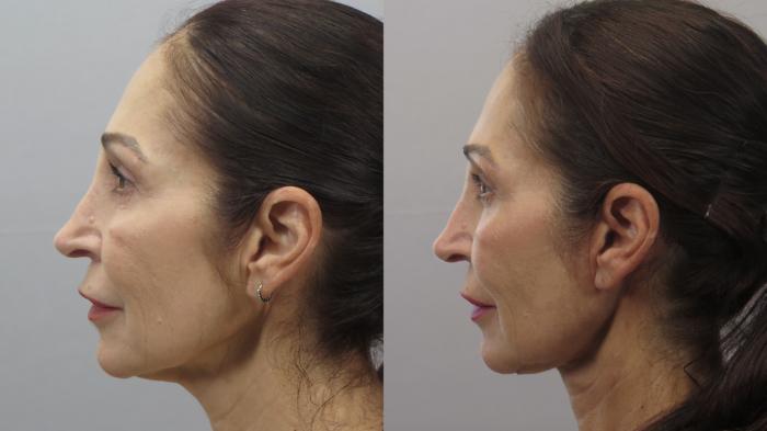 Neck Contouring Case 1579 Before & After Left Side | Paramus, New Jersey | Parker Center for Plastic Surgery