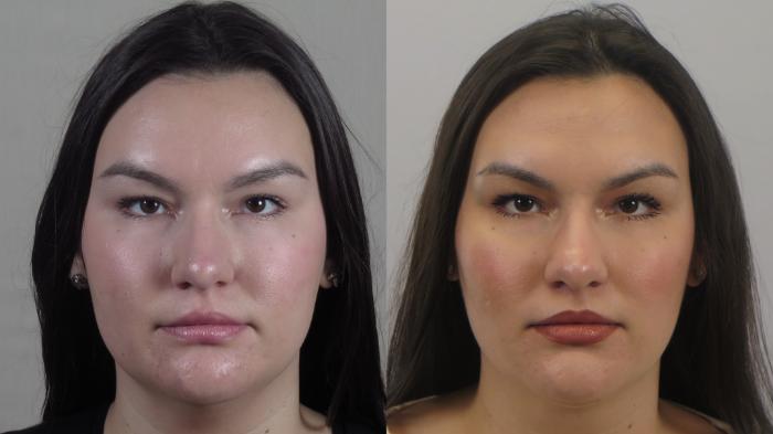 Neck Contouring Case 1581 Before & After Front | Paramus, New Jersey | Parker Center for Plastic Surgery
