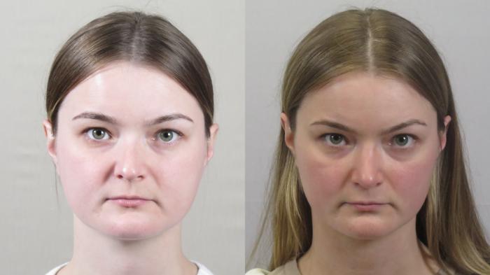 Neck Contouring Case 1591 Before & After Front | Paramus, New Jersey | Parker Center for Plastic Surgery