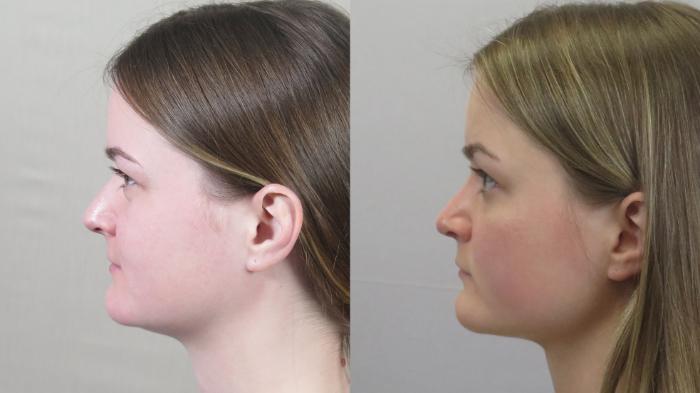 Neck Contouring Case 1591 Before & After Left Side | Paramus, New Jersey | Parker Center for Plastic Surgery