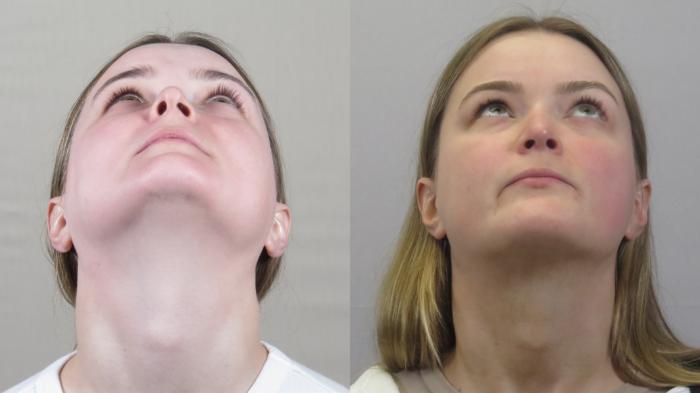Neck Contouring Case 1591 Before & After worms view | Paramus, New Jersey | Parker Center for Plastic Surgery