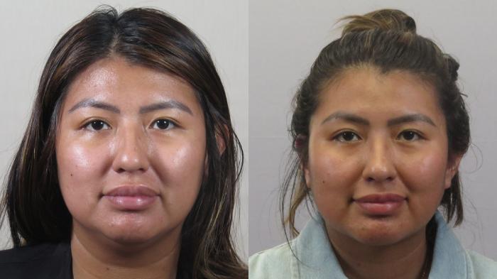 Neck Contouring Case 1597 Before & After Front | Paramus, New Jersey | Parker Center for Plastic Surgery