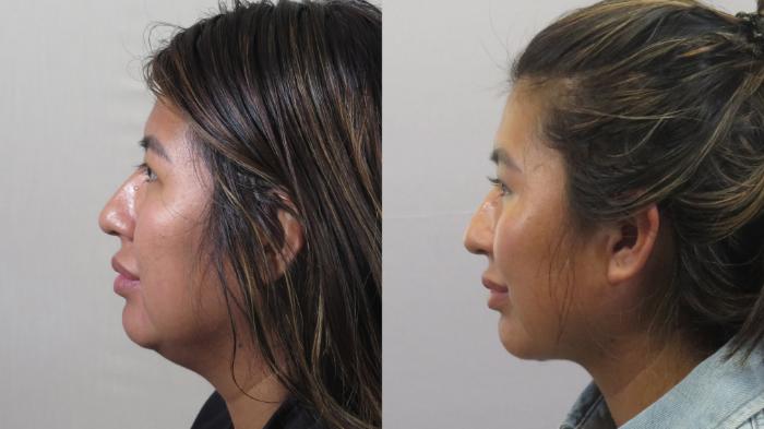 Neck Contouring Case 1597 Before & After Left Side | Paramus, New Jersey | Parker Center for Plastic Surgery