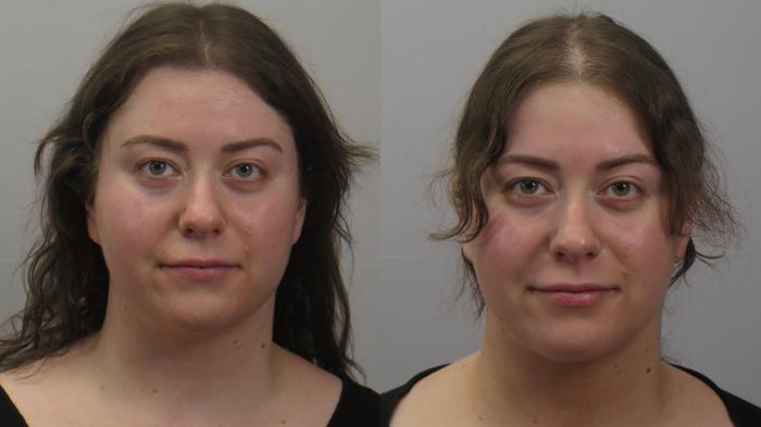 Neck Contouring Case 1616 Before & After Front | Paramus, New Jersey | Parker Center for Plastic Surgery