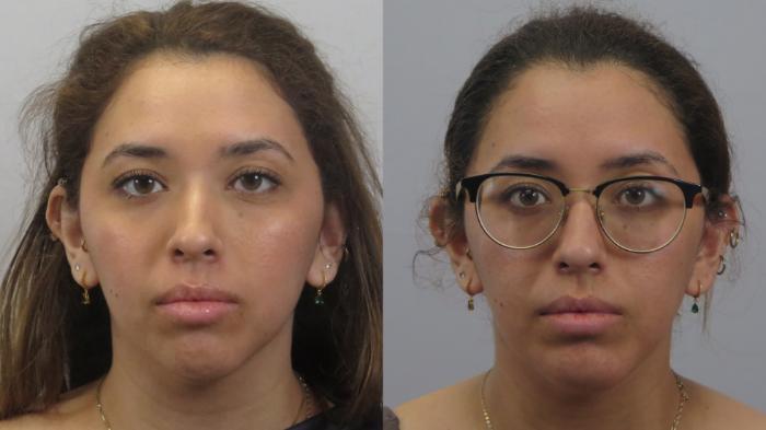 Neck Contouring Case 1625 Before & After Front | Paramus, New Jersey | Parker Center for Plastic Surgery