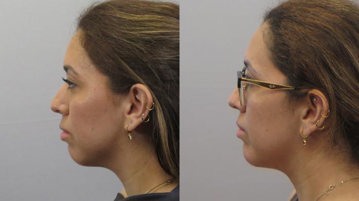 Neck Contouring Case 1625 Before & After Left Side | Paramus, New Jersey | Parker Center for Plastic Surgery