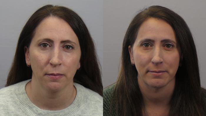 Neck Contouring Case 1626 Before & After Front | Paramus, New Jersey | Parker Center for Plastic Surgery