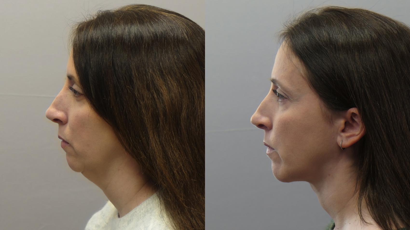 Neck Contouring Case 1626 Before & After Left Side | Paramus, New Jersey | Parker Center for Plastic Surgery