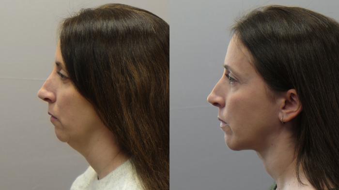 Neck Contouring Case 1626 Before & After Left Side | Paramus, New Jersey | Parker Center for Plastic Surgery