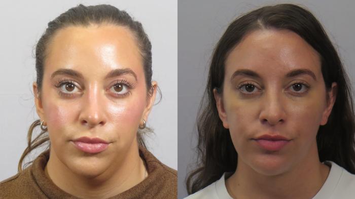 Neck Contouring Case 1628 Before & After Front | Paramus, New Jersey | Parker Center for Plastic Surgery