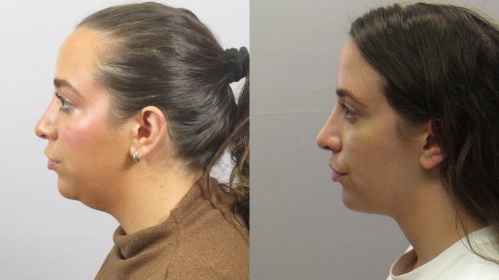 Neck Contouring Case 1628 Before & After Left Side | Paramus, New Jersey | Parker Center for Plastic Surgery