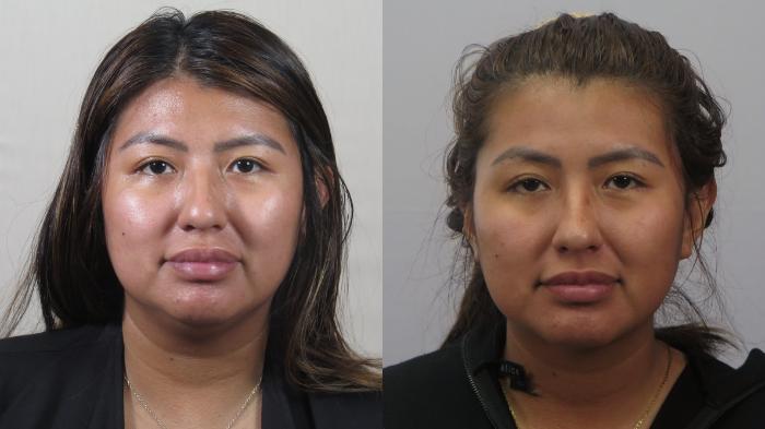 Neck Contouring Case 1629 Before & After Front | Paramus, New Jersey | Parker Center for Plastic Surgery