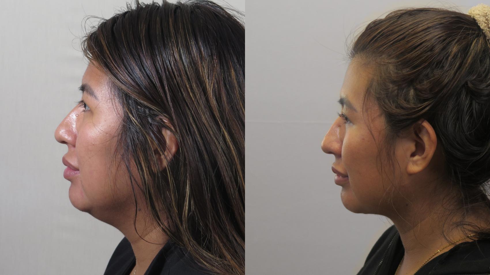 Neck Contouring Case 1629 Before & After Left Side | Paramus, New Jersey | Parker Center for Plastic Surgery