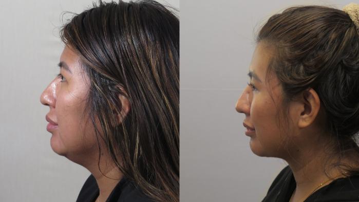 Neck Contouring Case 1629 Before & After Left Side | Paramus, New Jersey | Parker Center for Plastic Surgery