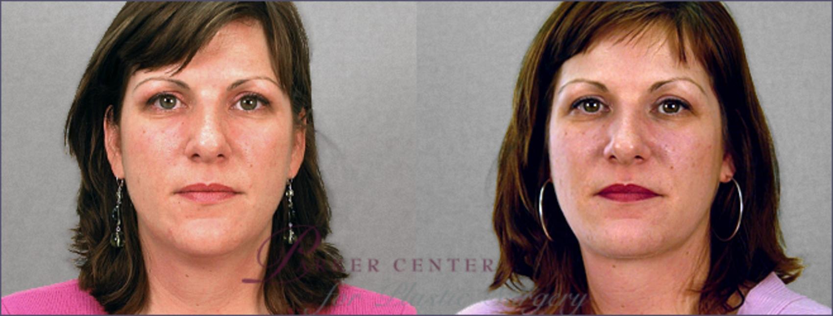 Neck Contouring Case 209 Before & After View #1 | Paramus, New Jersey | Parker Center for Plastic Surgery