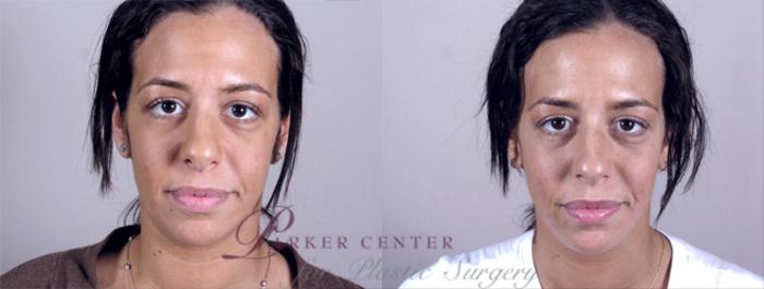 Neck Contouring Case 213 Before & After View #1 | Paramus, NJ | Parker Center for Plastic Surgery