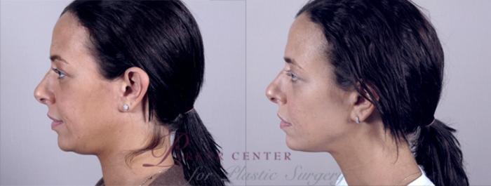 Neck Contouring Case 213 Before & After View #2 | Paramus, NJ | Parker Center for Plastic Surgery