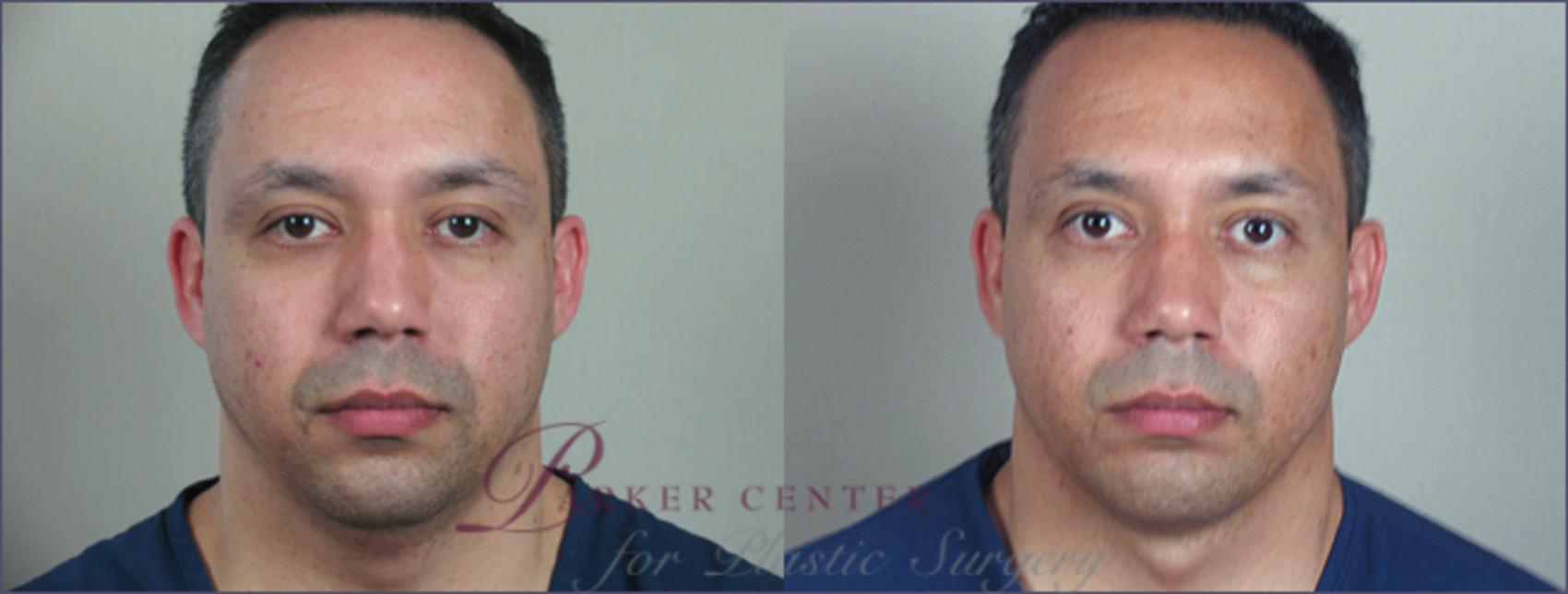 Neck Contouring Case 214 Before & After View #1 | Paramus, NJ | Parker Center for Plastic Surgery