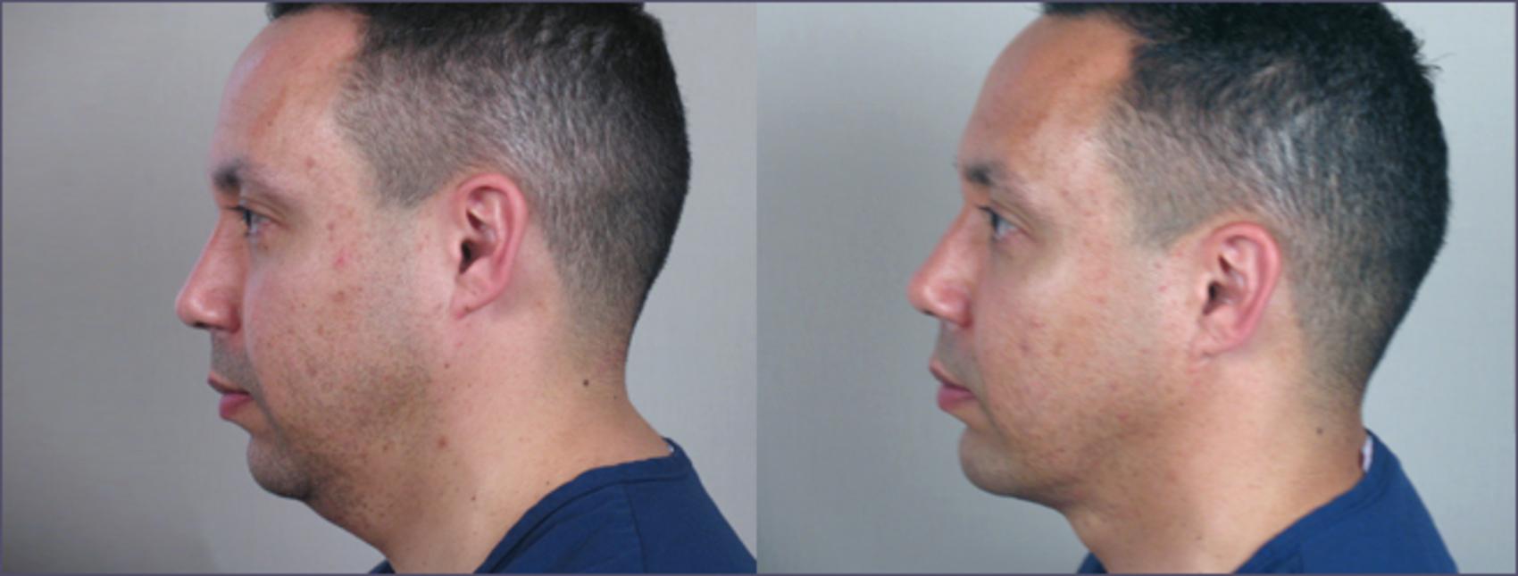 Neck Contouring Case 214 Before & After View #2 | Paramus, NJ | Parker Center for Plastic Surgery