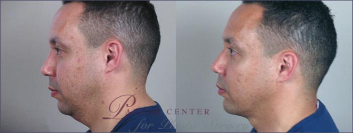 Neck Contouring Case 214 Before & After View #2 | Paramus, NJ | Parker Center for Plastic Surgery