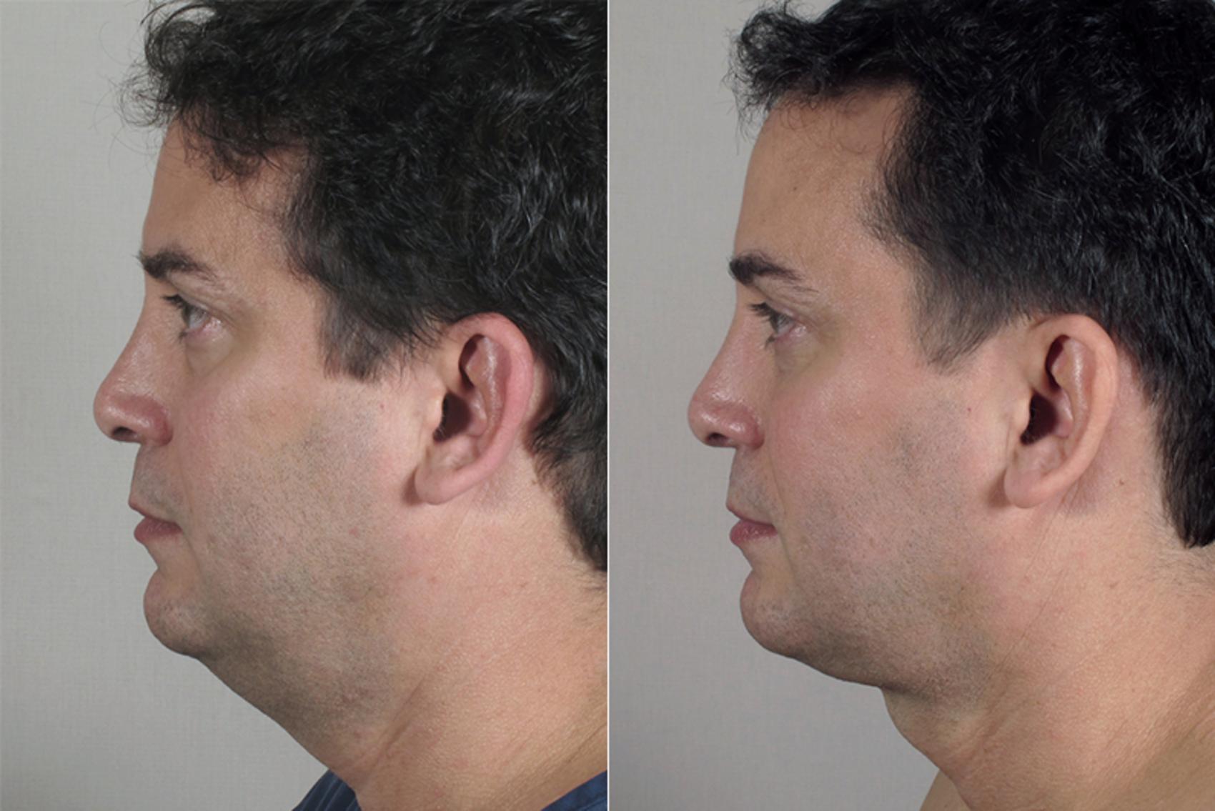 Neck Contouring Case 215 Before & After View #2 | Paramus, New Jersey | Parker Center for Plastic Surgery