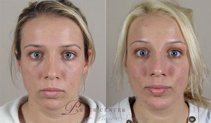 Cheek/Chin Implants Case 222 Before & After View #1 | Paramus, NJ | Parker Center for Plastic Surgery