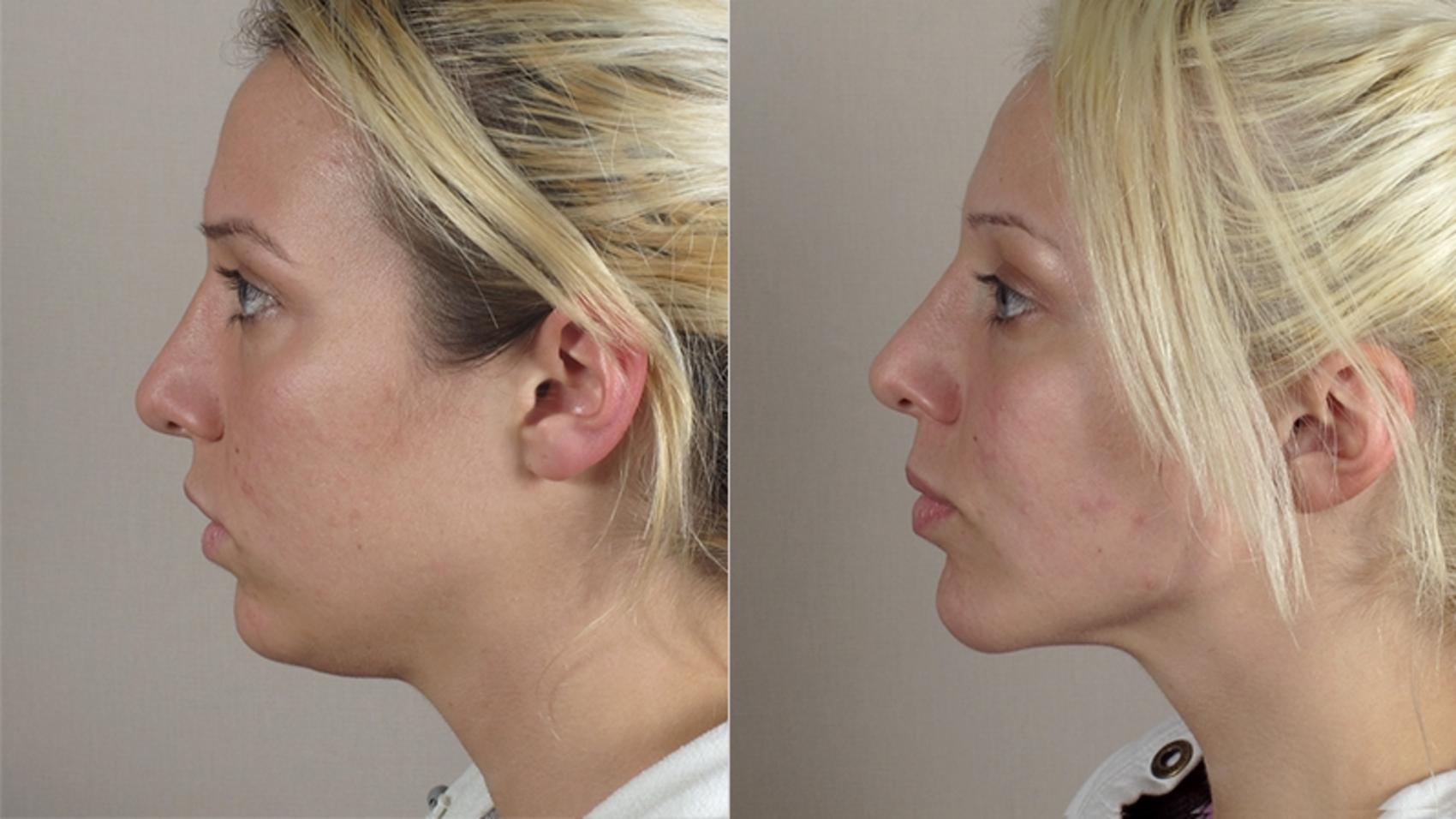 Chin Implants Case 222 Before & After View #2 | Paramus, New Jersey | Parker Center for Plastic Surgery