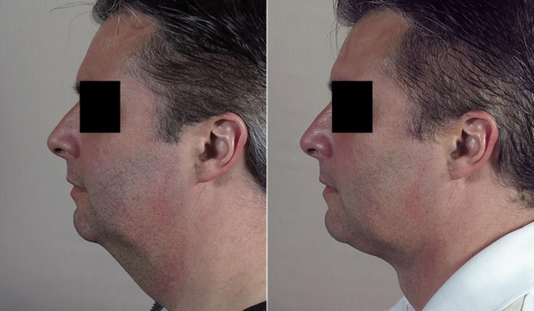 Neck Contouring Case 232 Before & After View #2 | Paramus, NJ | Parker Center for Plastic Surgery