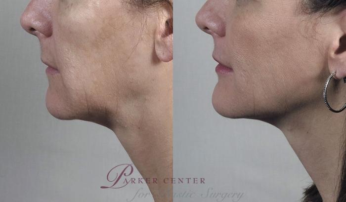 FaceTite Case 888 Before & After View #4 | Paramus, New Jersey | Parker Center for Plastic Surgery