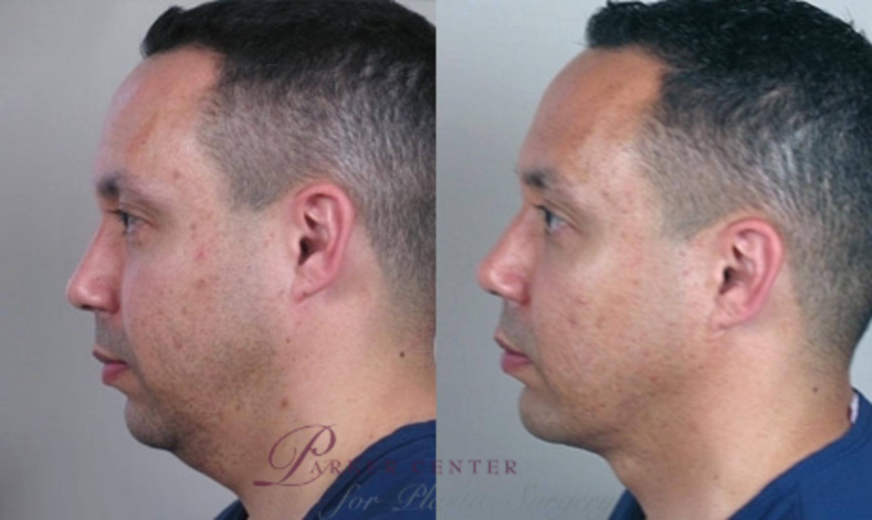 Neck Contouring Case 946 Before & After View #5 | Paramus, NJ | Parker Center for Plastic Surgery