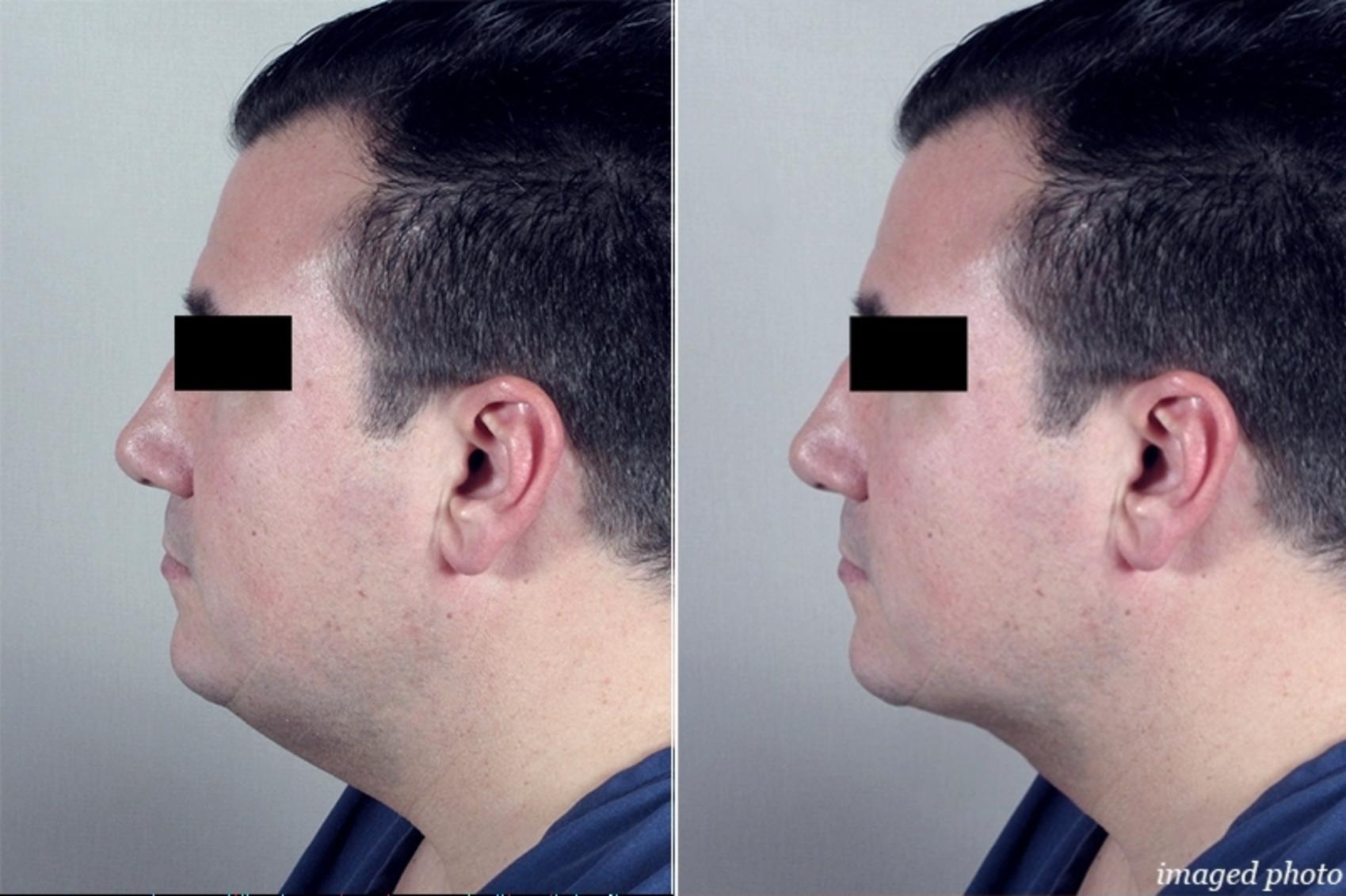 Neck Contouring Case 950 Before & After View #5 | Paramus, NJ | Parker Center for Plastic Surgery