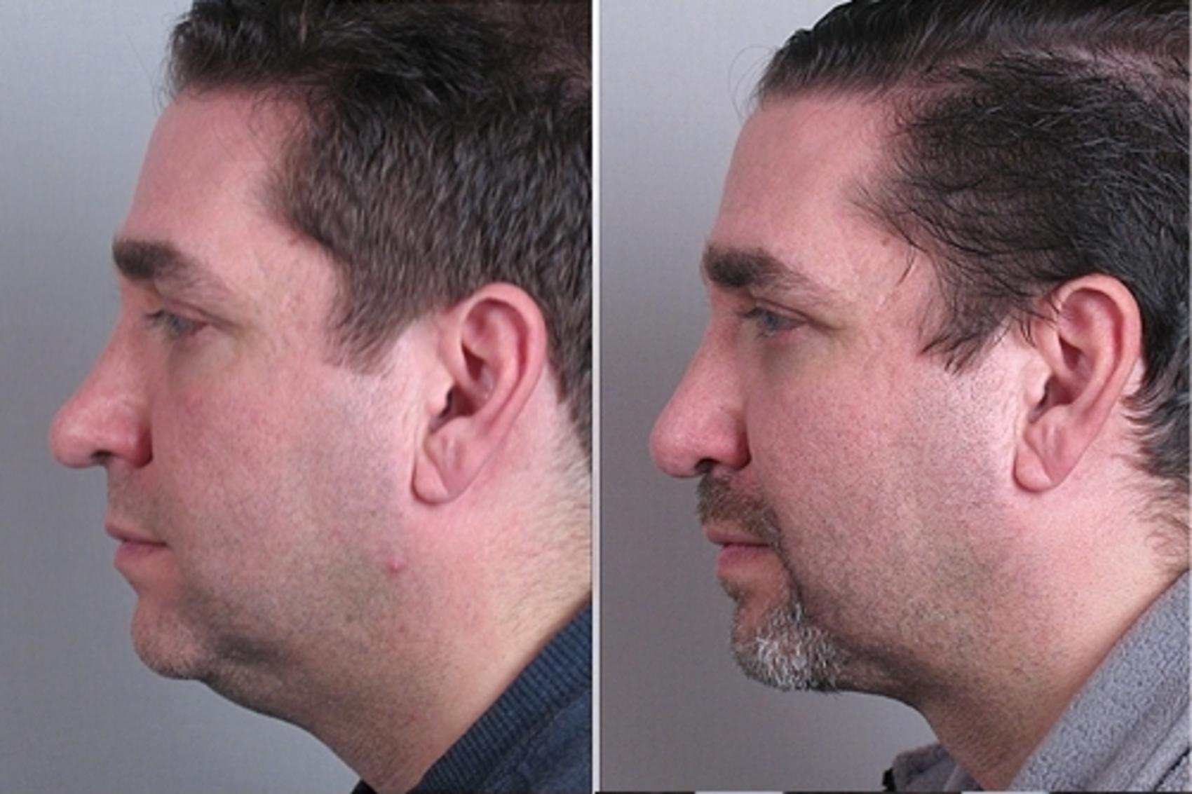 Neck Contouring Case 954 Before & After View #5 | Paramus, NJ | Parker Center for Plastic Surgery