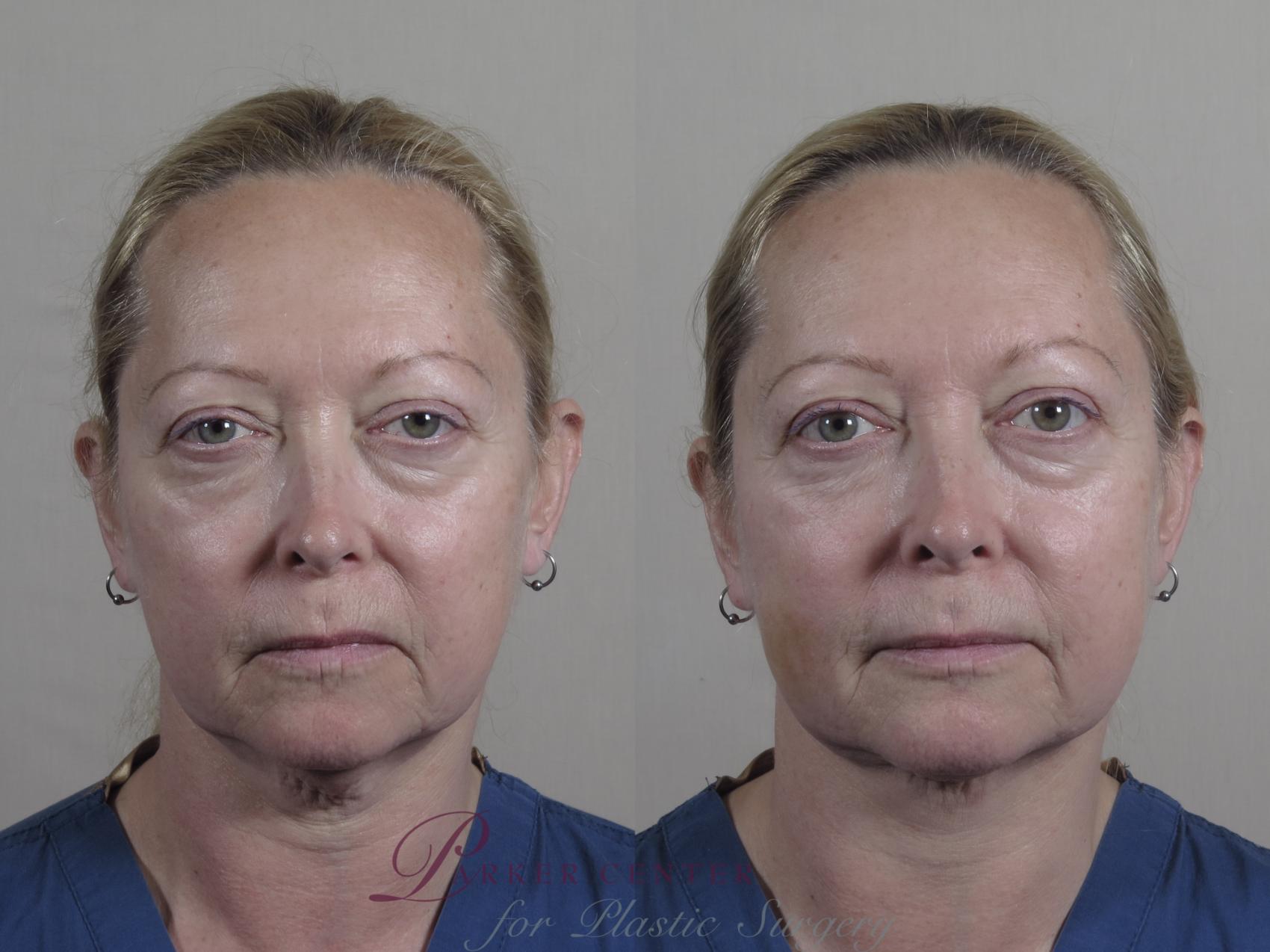 Nonsurgical Face Procedures Case 986 Before & After Front | Paramus, NJ | Parker Center for Plastic Surgery