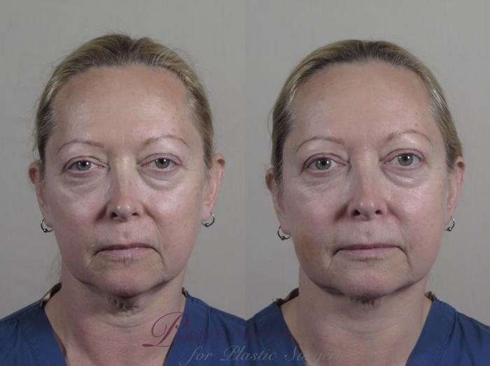 Nonsurgical Face Procedures Case 986 Before & After Front | Paramus, NJ | Parker Center for Plastic Surgery
