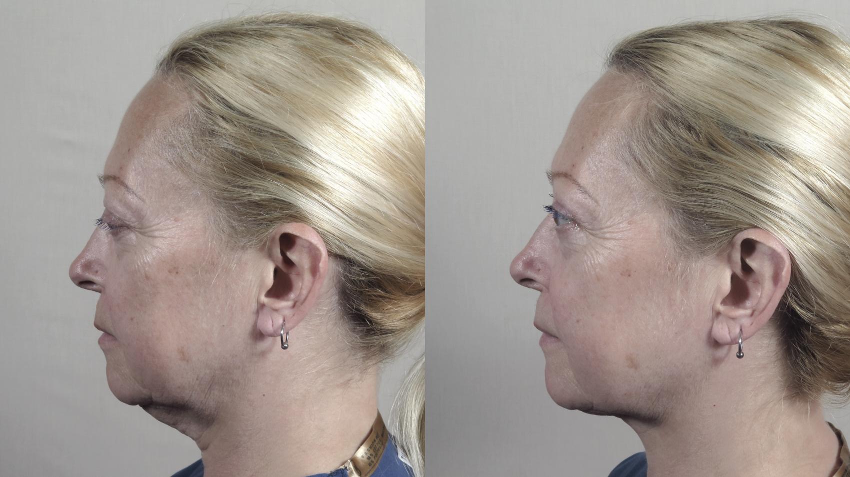 Neck Contouring Case 986 Before & After Left Side | Paramus, New Jersey | Parker Center for Plastic Surgery